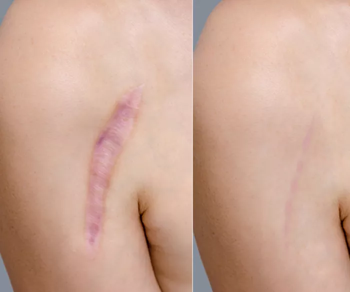 Scar Reduction2.webp